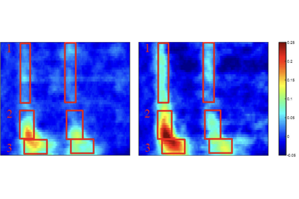 Research image of auditory processing in people with Phelan-McDermid syndrome.