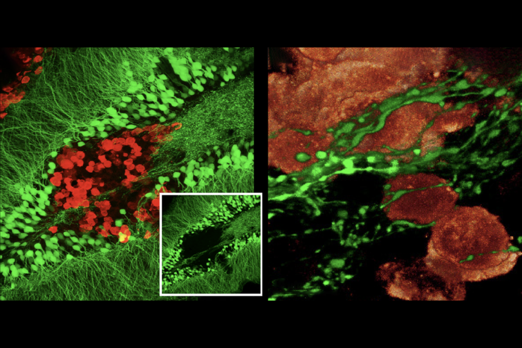 Research image of axons forming a path into brain metastases of small-cell lung cancer, integrating tumors into the brain.