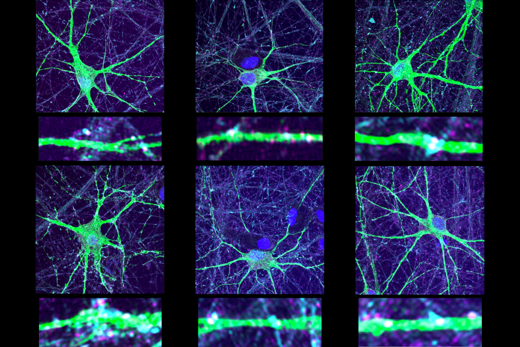 Research image of neurons with variants of the KCNQ2 gene (bottom row) developing more synaptic protein groups (pink and blue) than control neurons (top row).