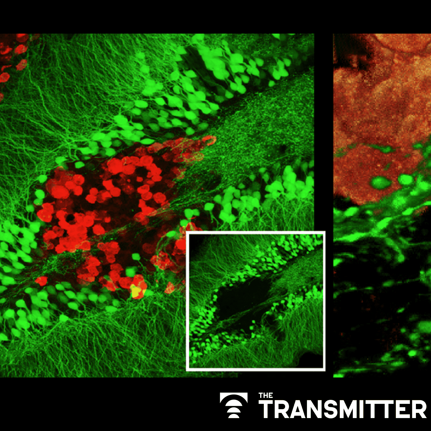 Neurons fuel lung tumors that have spread to brain episode artwork