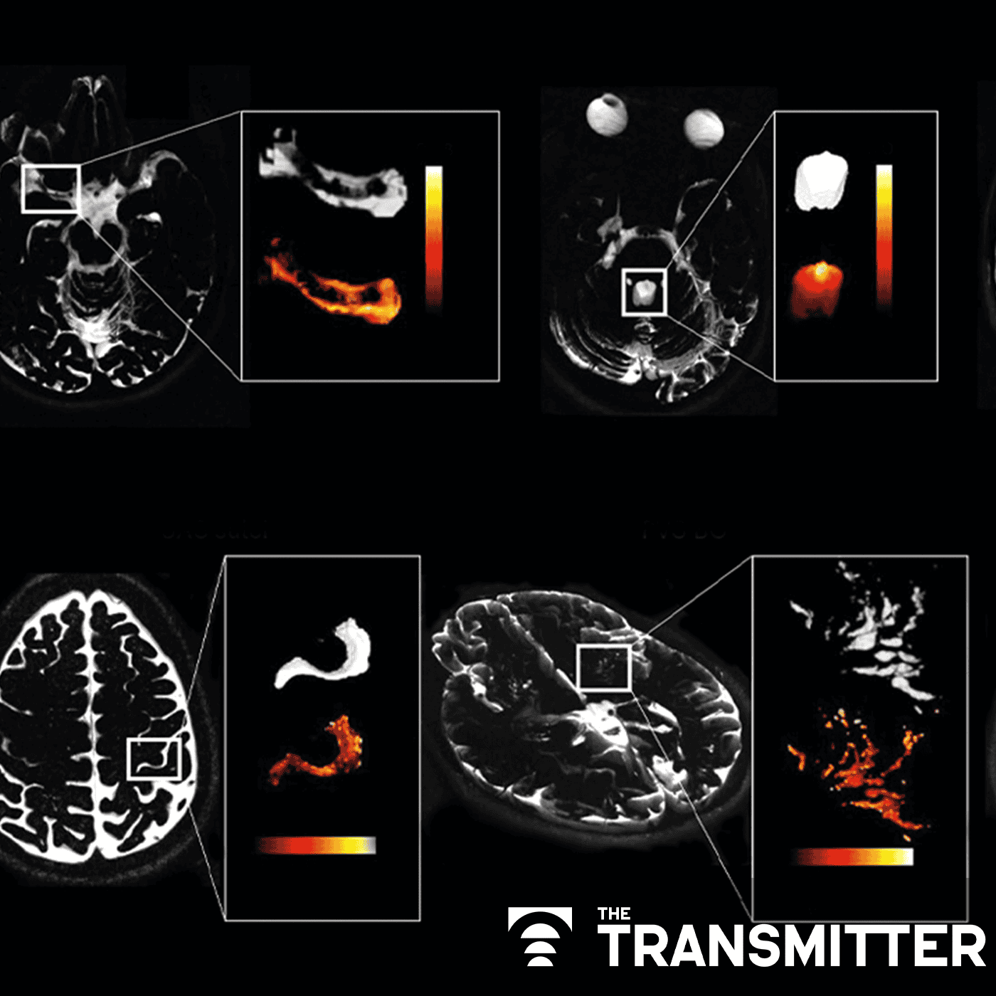 Noninvasive method lifts curtain on cerebrospinal-fluid dance in human brain episode artwork