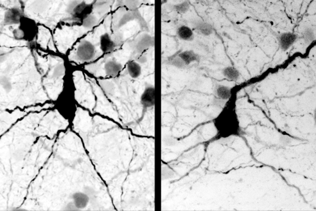 Neurons in cerebral organoids containing a MECP2 variant (right panel) have smaller cell bodies and fewer branches than those in wildtype organoids (left panel).