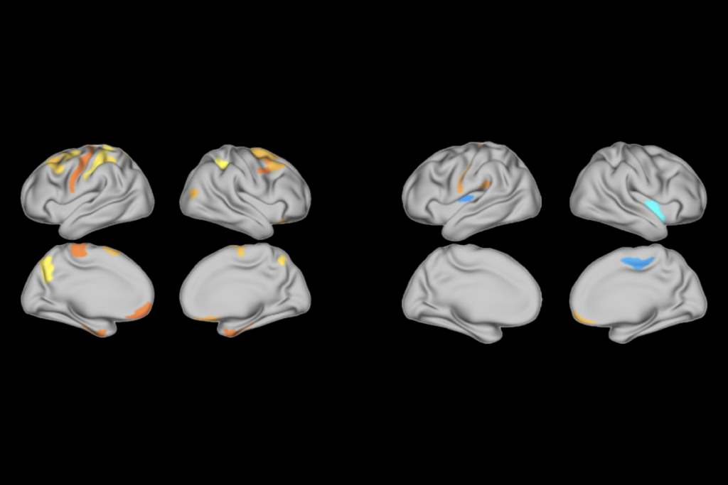 Brain scans showing people with autism have a thinner cortex in many brain regions than do people with ADHD, but greater measures of cortical curvature.