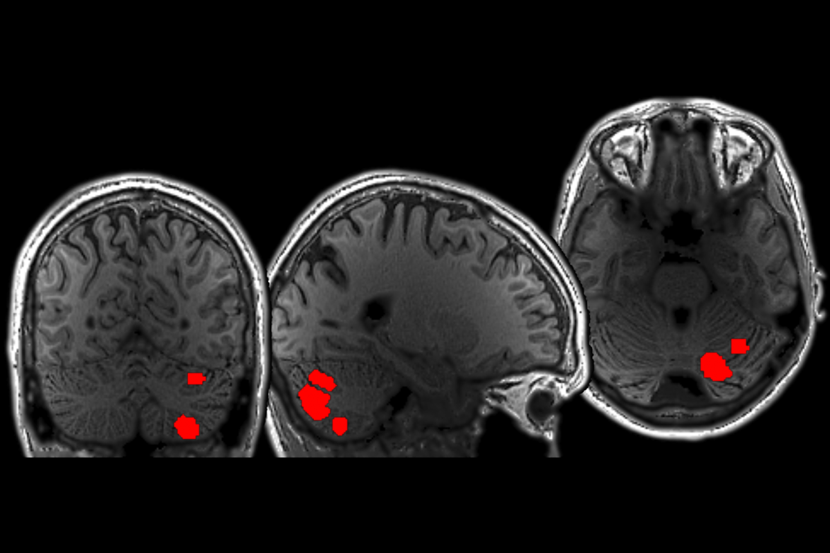 Language-responsive regions light up in red on a series of brain scans.