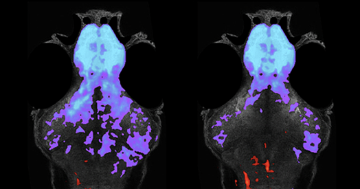 Descubren pistas en el cerebro de bebés con alto riesgo de autismo