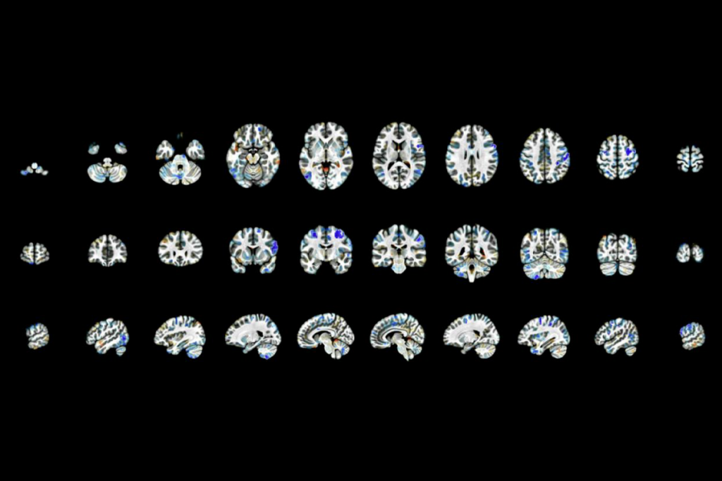 Research image showing brain activity related to sensory sensitivity and hypoconnectivity