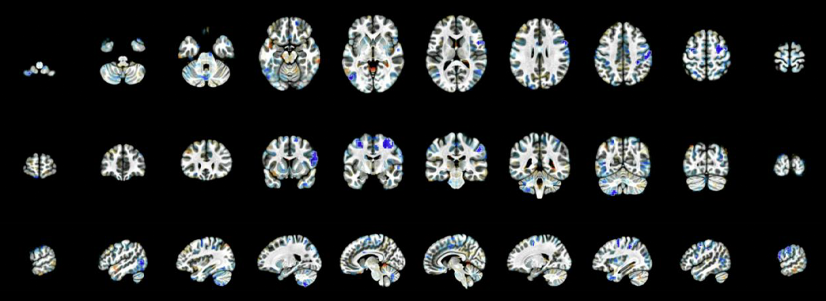 Research image showing brain activity related to sensory sensitivity and hypoconnectivity