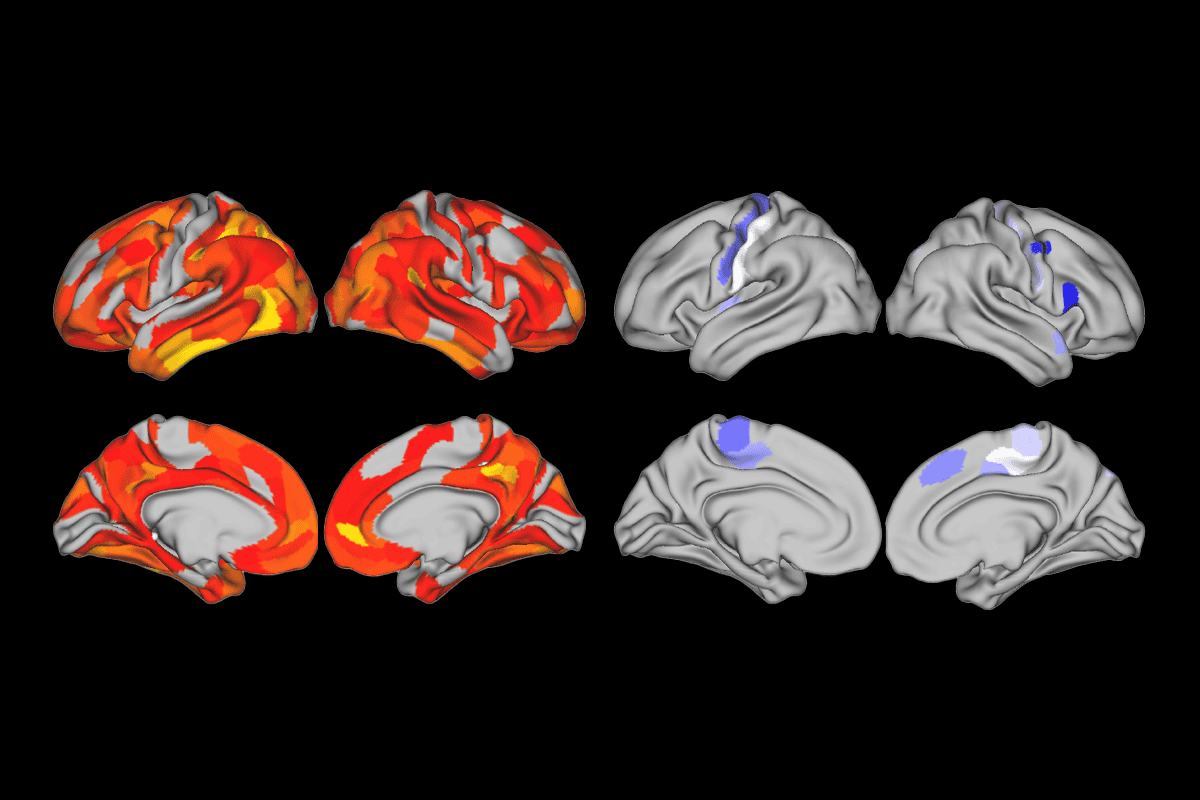Brain scans showing sex-based activation differences.