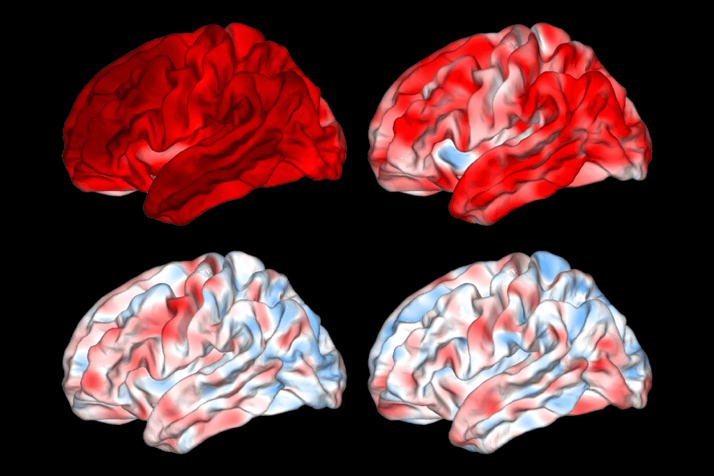 Structural MRI scans of people with Alzheimer’s disease and depression.
