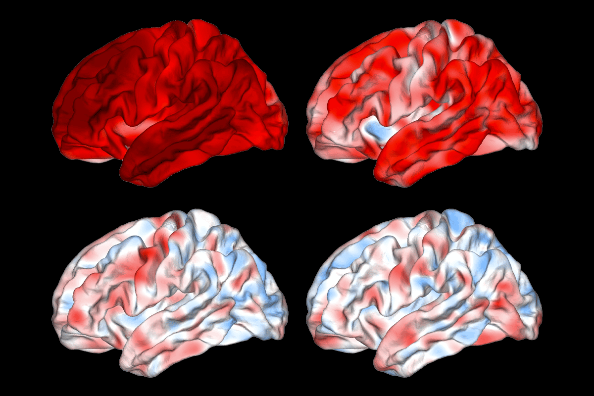Structural MRI scans of people with Alzheimer’s disease and depression.