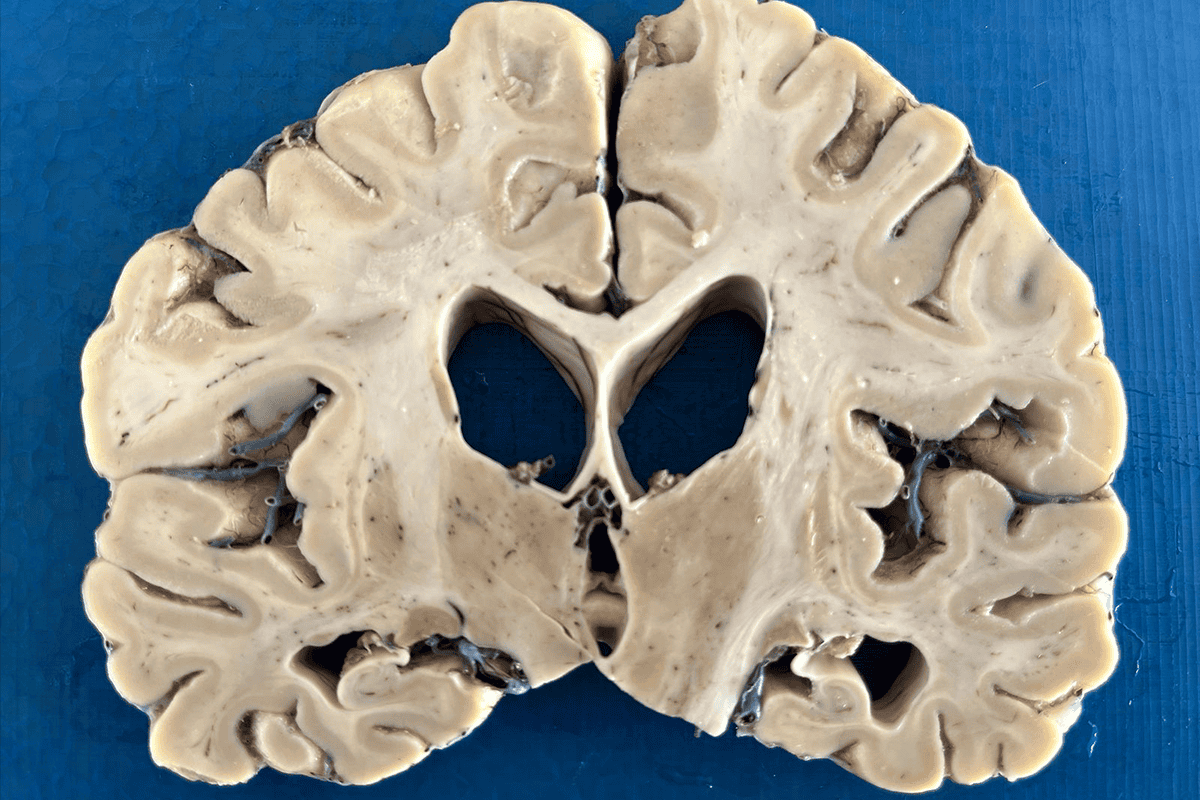 Brain donations allow researchers to study the tissue loss, enlarged ventricles and hippocampal atrophy associated with Alzheimer’s disease. (Published in the Journal of Alzheimer’s Disease, 2026.)
