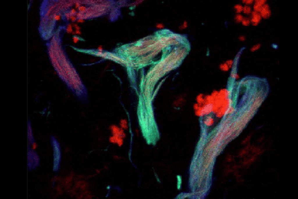 Stages of neurodegeneration: Neurofibrillary tangles at different stages of neurodegeneration are labeled with phosphorylated tau antibodies (green and blue).