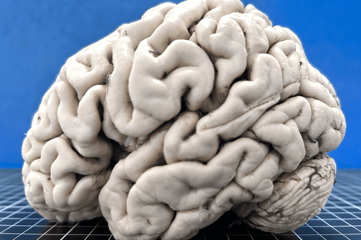 Brain of a person with Alzheimer’s diease.