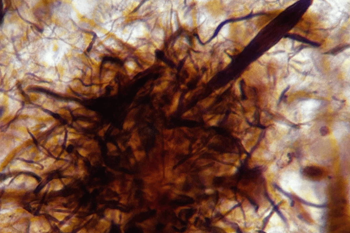 Silver-stained brain sample from a person with Alzheimer’s disease.