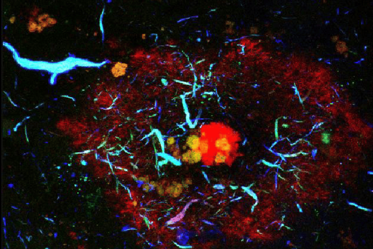 Alzheimer’s lesions.