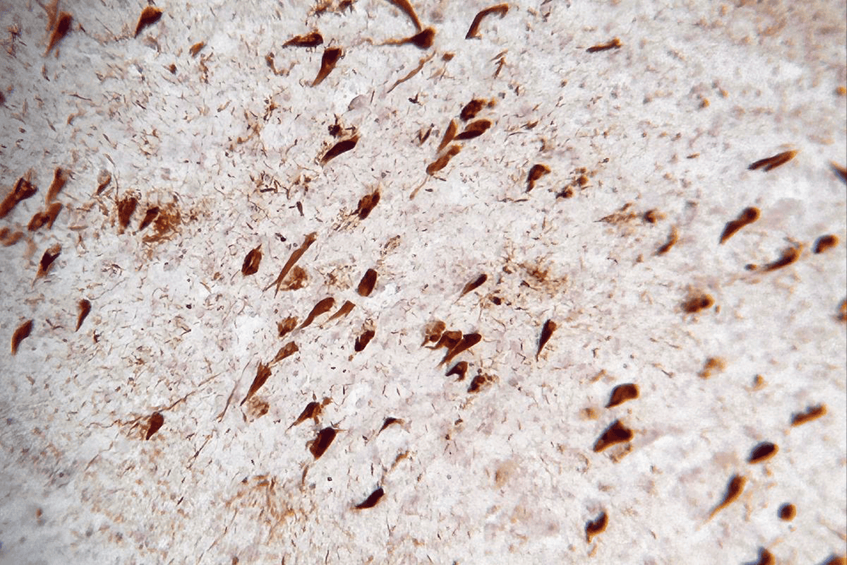 Neurofibrillary tangles in the brain of a person with Alzheimer’s disease.