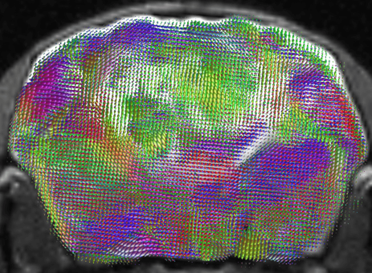 MRI scan of an estimated map of nerve-fiber pathways.