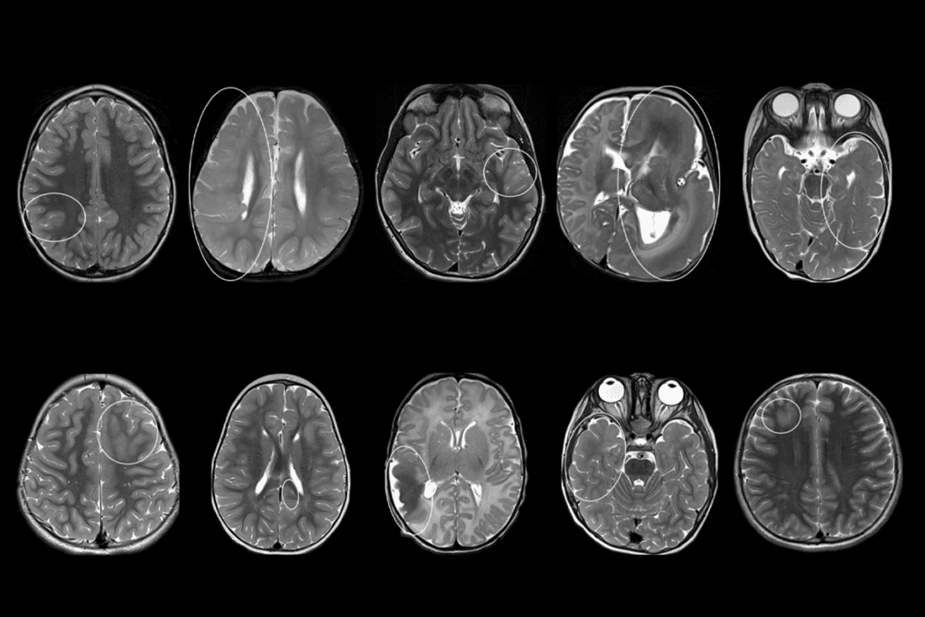 MRI images of malformations of cortical development.