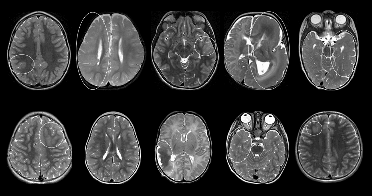 MRI images of malformations of cortical development.