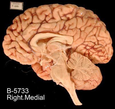 brain scan chromosome 22